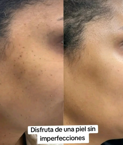 Wart Remover Ointment- Eliminador de Verrugas y Lunares