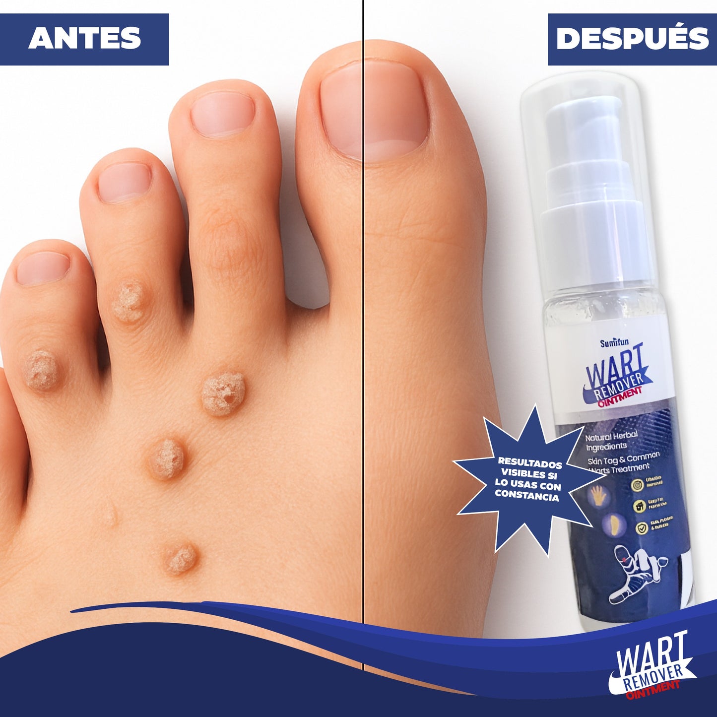 Wart Remover Ointment- Eliminador de Verrugas y Lunares