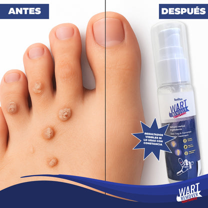 Wart Remover Ointment- Eliminador de Verrugas y Lunares